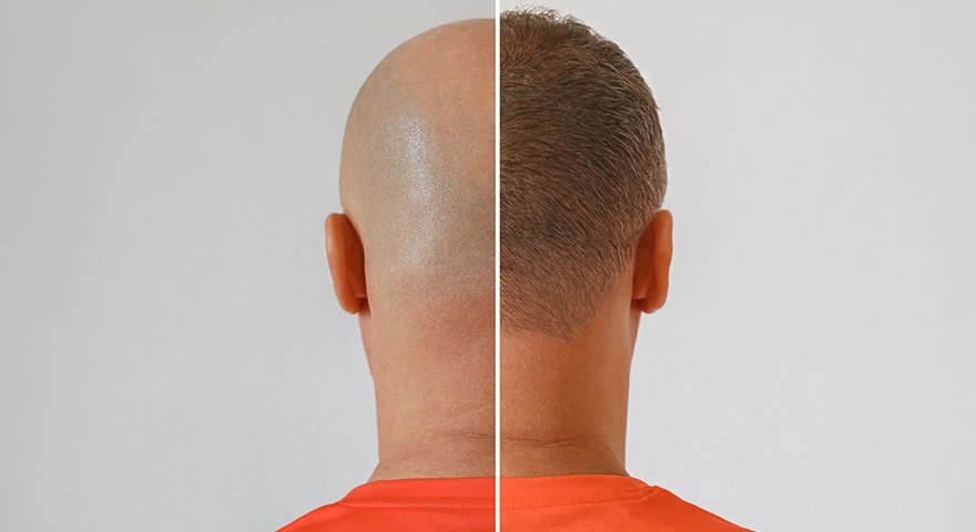 Hair Transplant