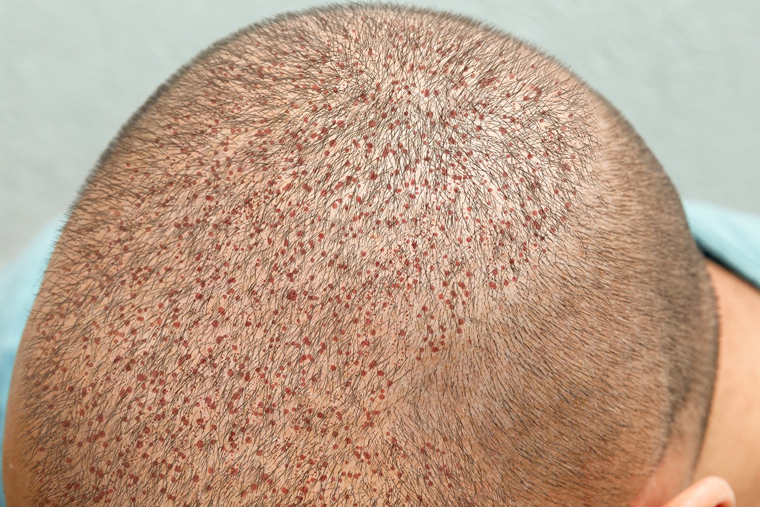 Why do we use it? - Sonrası