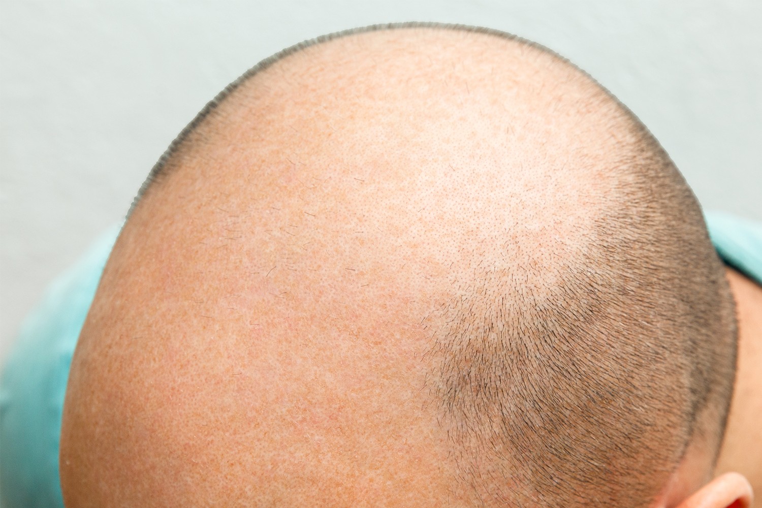 What is Lorem Ipsum? - Öncesi